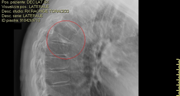 Crollo vertebrale nel rachide dorsale in corso di osteoporosi.