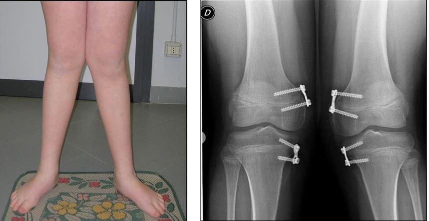 FIG.2-3: ginocchia valghe; trattamento chirurgico tramite epifisiodesi asimmetrica bilaterale (eight-plates) a livello dei femore distale mediale e tibia prossimale mediale.