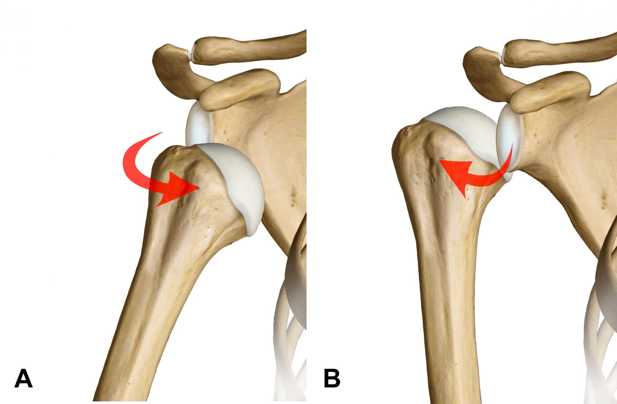 Fig. 2 - Rappresentazione delle più frequenti lussazioni gleno-omerali di spalla: A, lussazione anteriore; B, lussazione posteriore