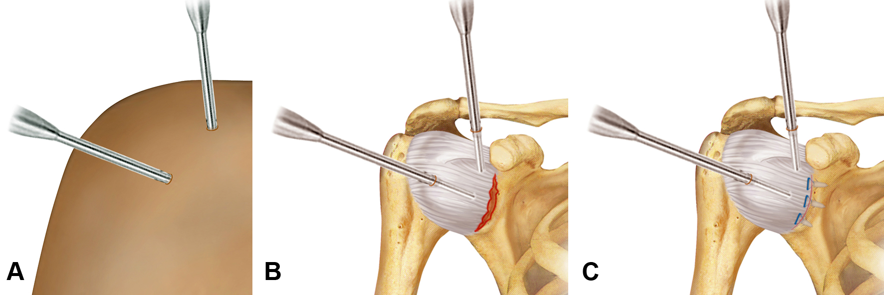 Fig. 3 - Capsuloplastica (stabilizzazione della spalla) artroscopica: A, accessi artroscopici (intervento mini-invasivo, non viene “aperta” la spalla, si praticano dei “fori” e l’intervento viene eseguito con ausilio di una telecamera da endoscopia); B, identificazione della lesione capsulare (in rosso); C, riparazione della lesione capsulare (in blu, vengono usate delle “ancorette” per fissare la capsula strappata all’osso)