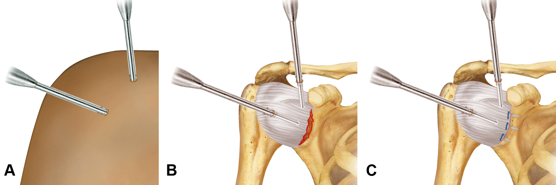 Fig. 3 - Capsuloplastica (stabilizzazione della spalla) artroscopica: A, accessi artroscopici (intervento mini-invasivo, non viene “aperta” la spalla, si praticano dei “fori” e l’intervento viene eseguito con ausilio di una telecamera da endoscopia); B, identificazione della lesione capsulare (in rosso); C, riparazione della lesione capsulare (in blu, vengono usate delle “ancorette” per fissare la capsula strappata all’osso)