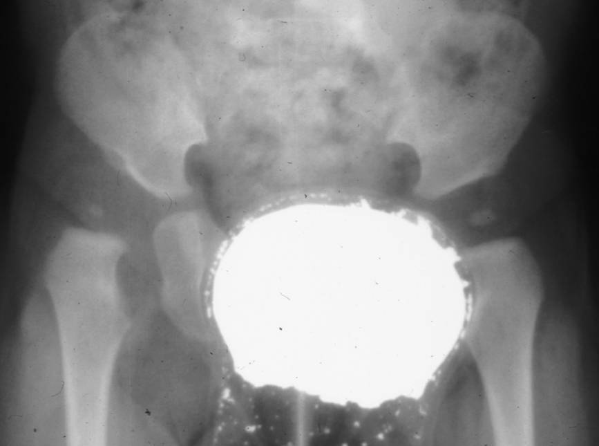 Fig.1 - Esempio di lussazione congenita anca destra. L'epifisi femorale risulta dislocata e 'risalita' in direzione craniale. Il tetto acetabolare appare smussato