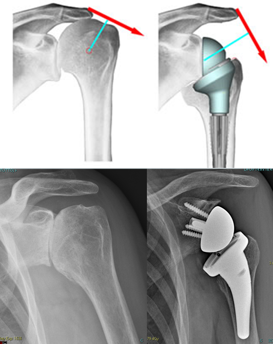 Fig. 14 – Artrosi della spalla trattata con l’impianto di protesi inversa a stelo corto e non cementata, con risparmio di tessuto osseo ospite