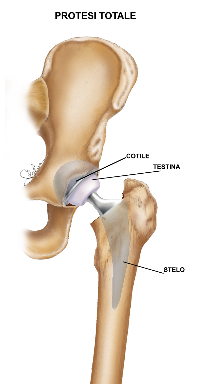Fig. 3 - Protesi totale dell'anca