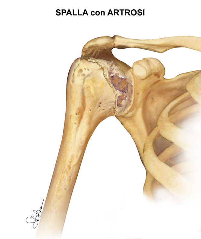 Fig. 5 - Spalla artrosica
