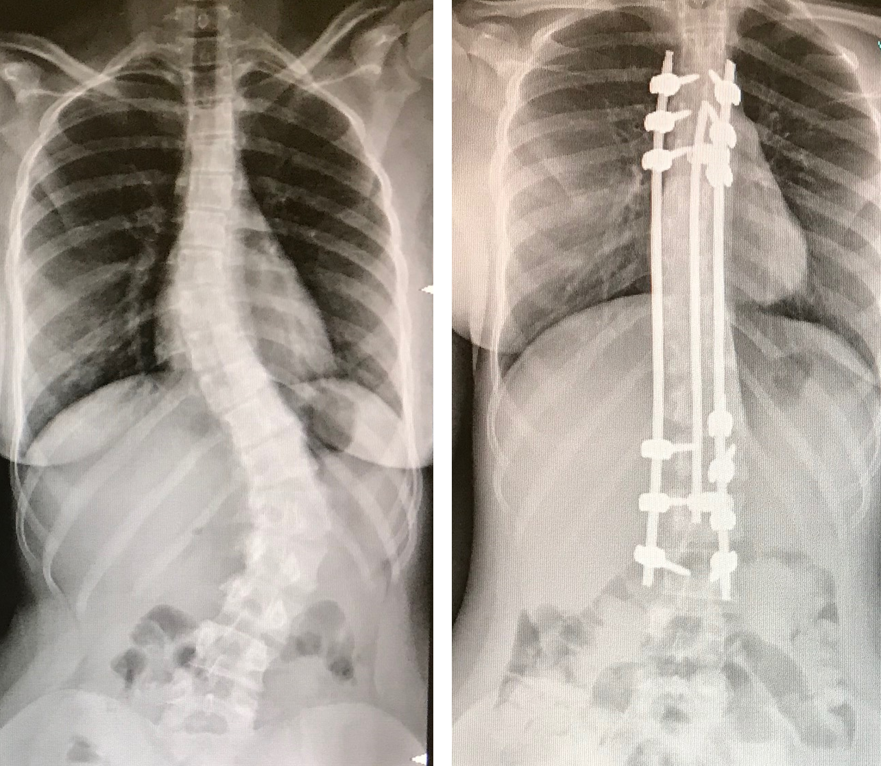 Trattamento della scoliosi con la tecnica innovativa descritta: immagine radiografica prima e dopo l'intervento