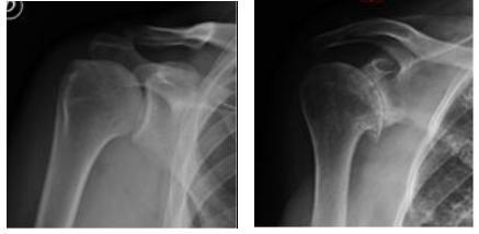 Figg. 3-4: Radiografia di una spalla normale e di una spalla artrosica