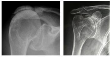Figg. 5-6: Radiografia di una spalla con artropatia da lesione inveterata di cuffia e di una spalla con artrite reumatoide