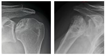 Figg. 7-8: Radiografia di una spalla con necrosi della testa omerale e di una spalla con artrosi e necrosi  post-traumatica