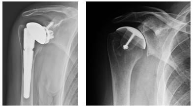 Figg. 9-10: Protesi di spalla anatomica totale: componente omerale con stelo, componente glenoidea con metal back; Protesi di rivestimento