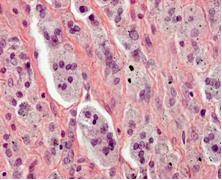 Tissue reaction in case of failure of hip prostheses with metal-polyethylene coupling Tissue reaction in case of failure of hip prostheses with metal-polyethylene coupling