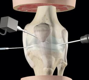 Fig. 4 - L’artroscopia è una tecnica chirurgica mini-invasiva che consente di operare a cielo chiuso senza “aprire” le articolazioni. Questo significa minore invasività, minori percentuali di complicanze, recupero post-operatorio più veloce rispetto agli interventi tradizionali a cielo aperto
